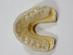 An image of a clear gum guard